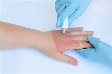 یکم دی روز ملی پیشگیری از سوختگی؛ آماری فراتر از حادثه